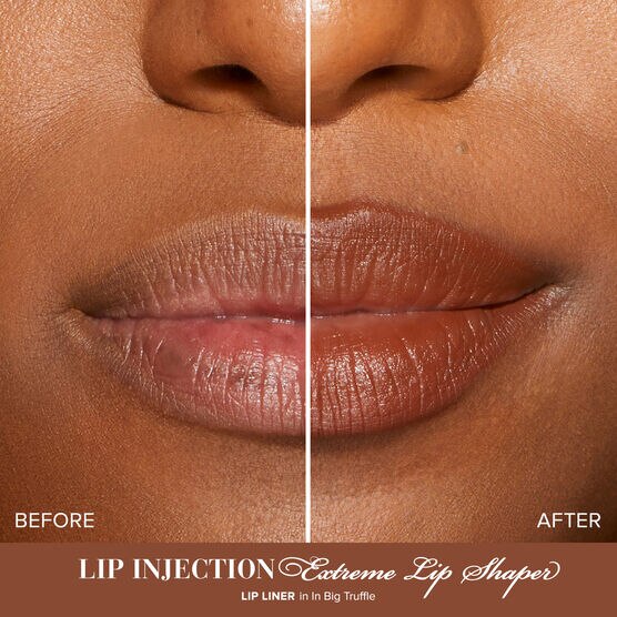 Lip Injection L�pis Boca In Big Truffle